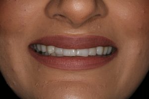 Before - Shirley Dental